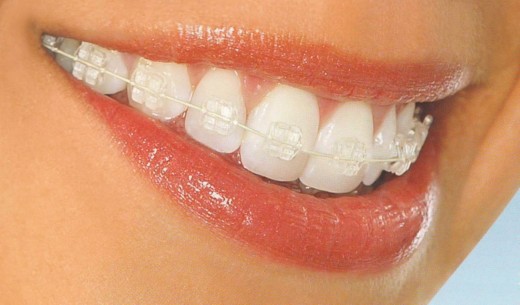 Как стоматологи исправляют прикус