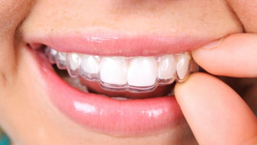 Преимущества трейнеров для зубов