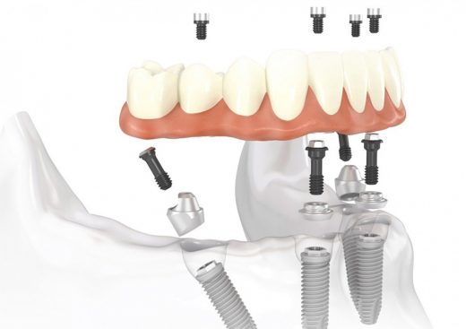 Имплантация зубов All-on-4 – новая улыбка в стоматологическом центре «Зууб»