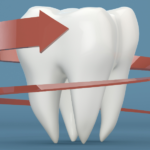 Реминерализация – как укрепить зубную эмаль?