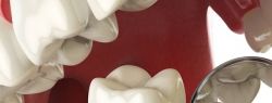 Экспресс-имплантация: качественное восстановление зубов до конца года