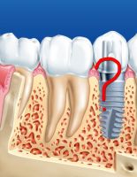 Полезная информация от стоматологических клиник Воронежа: противопоказания имплантации зубов