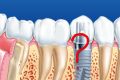 Полезная информация от стоматологических клиник Воронежа: противопоказания имплантации зубов