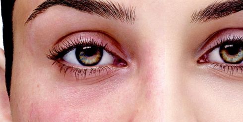 Средства от купероза и розацеи