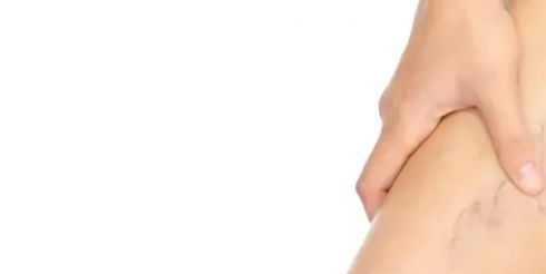 Лечение варикоза