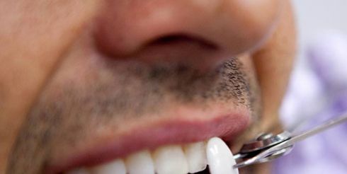 Что такое зубные виниры и каковы их разновидности