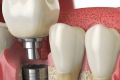 Имплантация зубов: существующие противопоказания